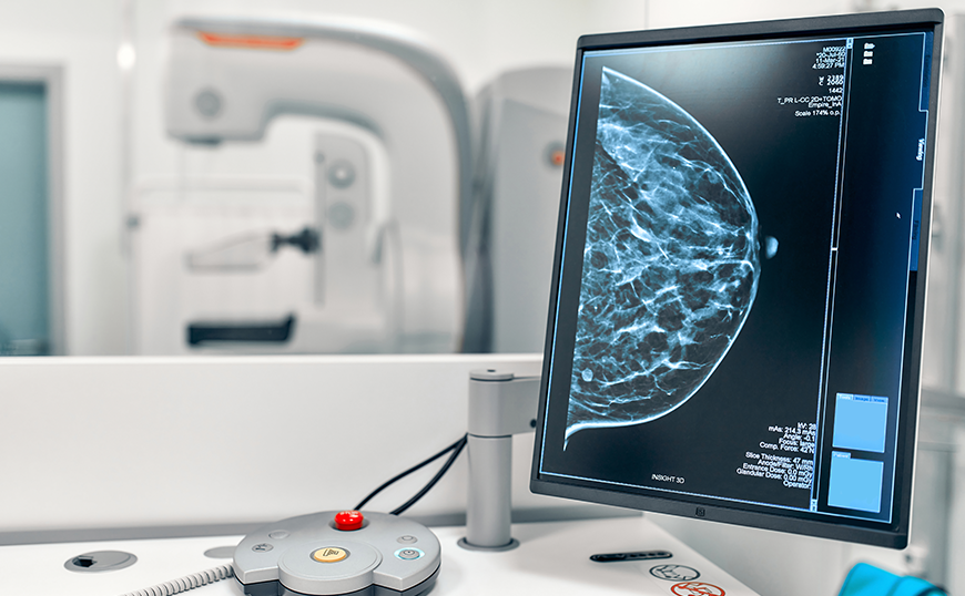 Mamografía 3D: Tu mejor aliada en la lucha contra el cáncer de mama 1 mamografia.artículo